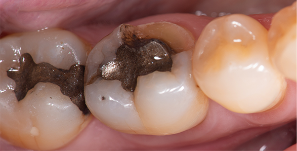 White Fillings in Witham and Seven Kings | Dental Wizards